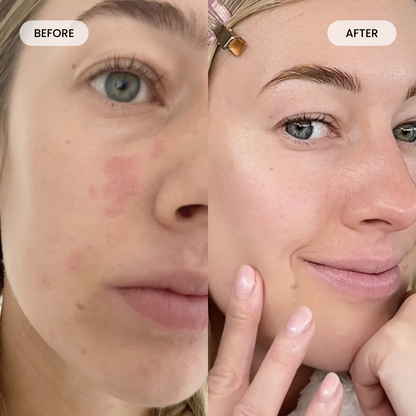 Get Lumoris Radiance Pro LED Light Therapy Face Mask
