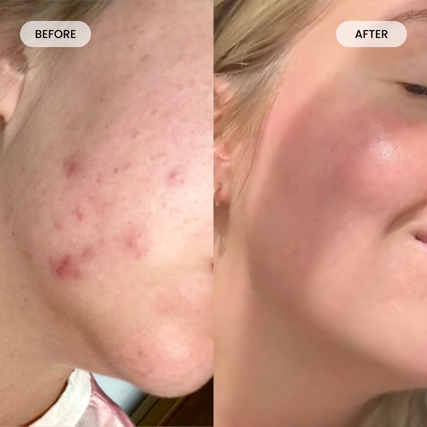 Get Lumoris Radiance Pro LED Light Therapy Face Mask