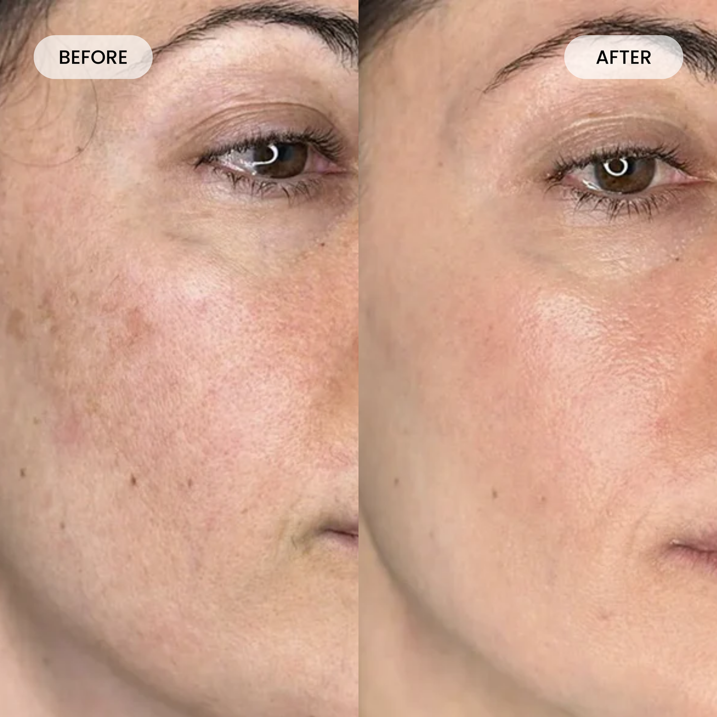 Get Lumoris Radiance Pro LED Light Therapy Face Mask